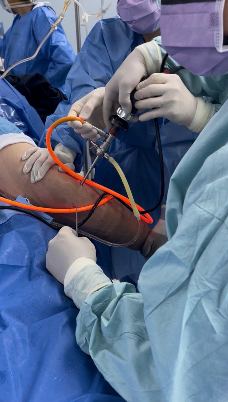 Resonancia magnética mostrando ruptura de ligamento cruzado anterior (LCA) en rodilla